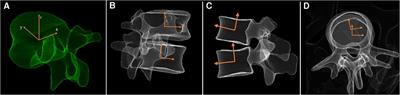 Correcting intervertebral rotation and scoliosis simultaneously by oblique lumbar interbody fusion: a 3D analysis of EOS images